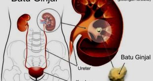 Langkah-langkah kebiasaan sehat yang efektif untuk mencegah batu ginjal terbentuk kembali
