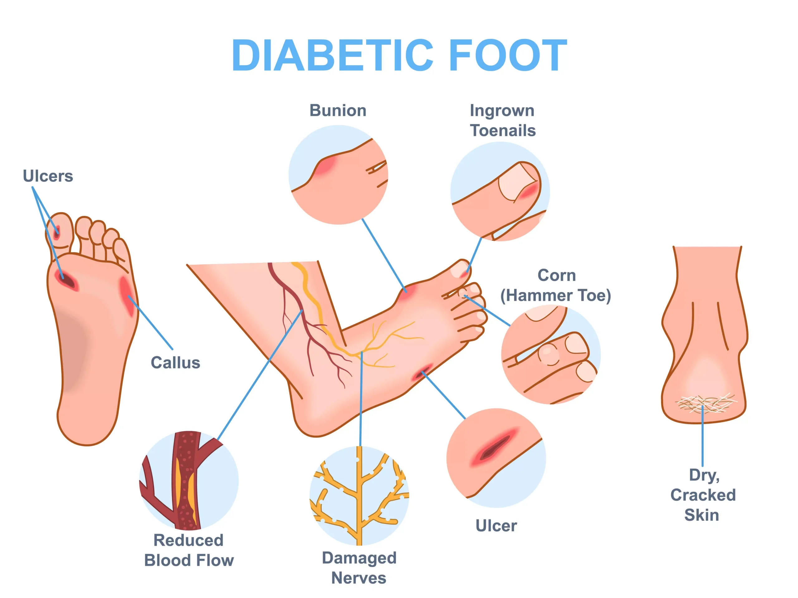 diabetes tipe 2 pada orang dewasa