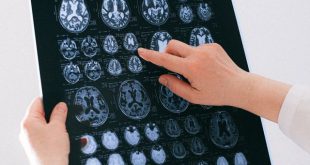 stroke batang otak gejala bahaya
