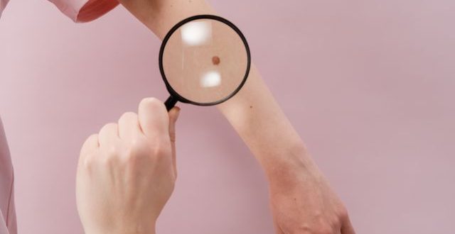penjelasan penyakit kanker kulit akibat paparan sinar matahari berlebih