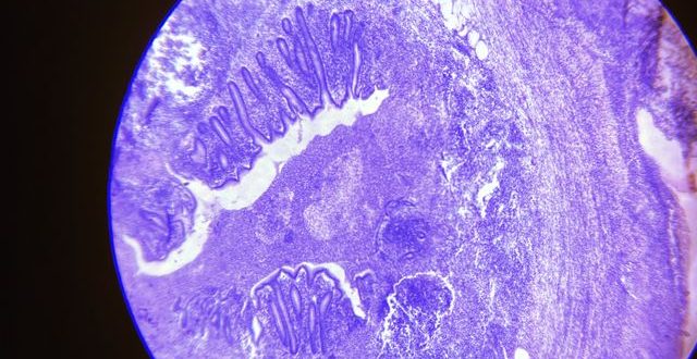 proses pemeriksaan biopsi kanker mengambil sampel jaringan untuk dilihat di laboratorium