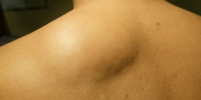 ciri benjolan lemak yang muncul di kelopak mata, siku atau lutut akibat kolesterol tinggi